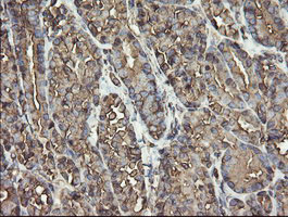 PDIA3 / ERp57 Antibody - IHC of paraffin-embedded Carcinoma of Human thyroid tissue using anti-PDIA3 mouse monoclonal antibody.