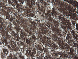 PDIA3 / ERp57 Antibody - IHC of paraffin-embedded Carcinoma of Human liver tissue using anti-PDIA3 mouse monoclonal antibody. (Heat-induced epitope retrieval by 10mM citric buffer, pH6.0, 120°C for 3min).