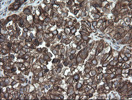 PDIA3 / ERp57 Antibody - IHC of paraffin-embedded Adenocarcinoma of Human ovary tissue using anti-PDIA3 mouse monoclonal antibody. (Heat-induced epitope retrieval by 10mM citric buffer, pH6.0, 120°C for 3min).