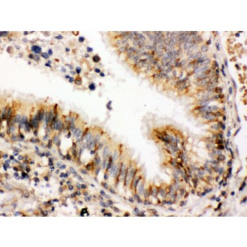 PDIA3 / ERp57 Antibody - ERp57 antibody IHC-paraffin. IHC(P): Human Lung Cancer Tissue.