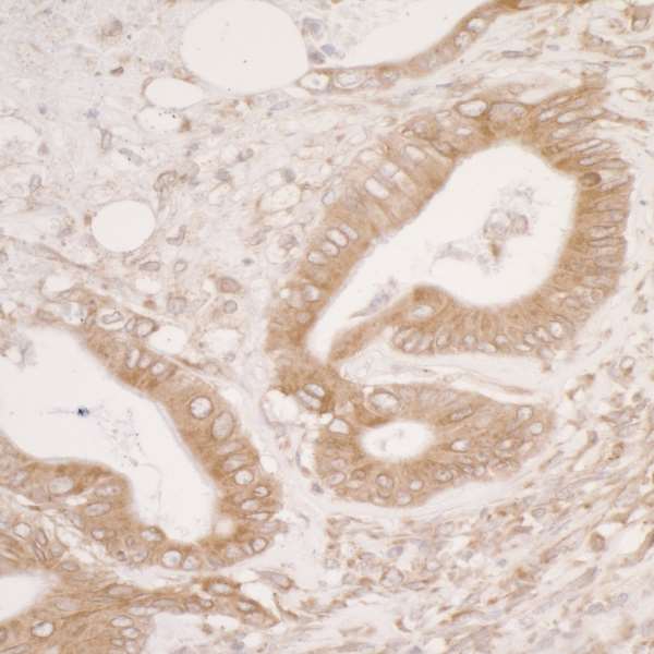 PDIA3 / ERp57 Antibody - Detection of human PDIA3 by immunohistochemistry. Sample: FFPE section of human colon carcinoma. Antibody: Affinity purified rabbit anti-PDIA3 used at a dilution of 1:5,000 (0.2µg/ml). Detection: DAB. Counterstain: IHC Hematoxylin (blue).