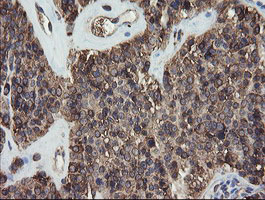 PDIA3 / ERp57 Antibody - IHC of paraffin-embedded Carcinoma of Human pancreas tissue using anti-PDIA3 mouse monoclonal antibody.