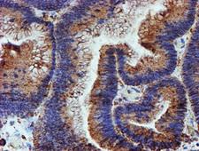PDIA4 / ERP72 Antibody - IHC of paraffin-embedded Adenocarcinoma of Human colon tissue using anti-PDIA4 mouse monoclonal antibody.