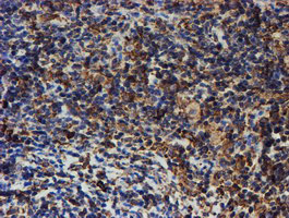 PDIA4 / ERP72 Antibody - IHC of paraffin-embedded Human lymphoma tissue using anti-PDIA4 mouse monoclonal antibody.