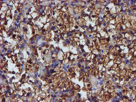 PDIA4 / ERP72 Antibody - IHC of paraffin-embedded Carcinoma of Human kidney tissue using anti-PDIA4 mouse monoclonal antibody.