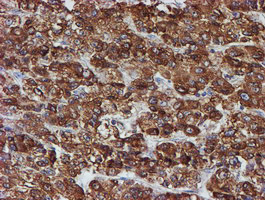 PDIA4 / ERP72 Antibody - IHC of paraffin-embedded Carcinoma of Human liver tissue using anti-PDIA4 mouse monoclonal antibody.