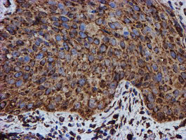 PDIA4 / ERP72 Antibody - IHC of paraffin-embedded Carcinoma of Human bladder tissue using anti-PDIA4 mouse monoclonal antibody.