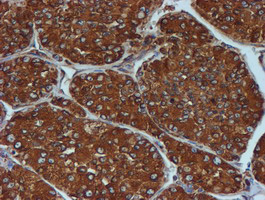 PDIA4 / ERP72 Antibody - IHC of paraffin-embedded Carcinoma of Human liver tissue using anti-PDIA4 mouse monoclonal antibody. (Heat-induced epitope retrieval by 10mM citric buffer, pH6.0, 100C for 10min).