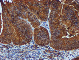 PDIA4 / ERP72 Antibody - IHC of paraffin-embedded Adenocarcinoma of Human endometrium tissue using anti-PDIA4 mouse monoclonal antibody. (Heat-induced epitope retrieval by 10mM citric buffer, pH6.0, 100C for 10min).