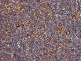 PDIA4 / ERP72 Antibody - IHC of paraffin-embedded Human lymphoma tissue using anti-PDIA4 mouse monoclonal antibody. (Heat-induced epitope retrieval by 10mM citric buffer, pH6.0, 100C for 10min).