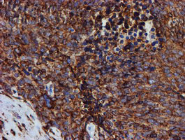 PDIA4 / ERP72 Antibody - IHC of paraffin-embedded Adenocarcinoma of Human breast tissue using anti-PDIA4 mouse monoclonal antibody. (Heat-induced epitope retrieval by 10mM citric buffer, pH6.0, 100C for 10min).