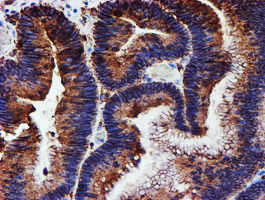 PDIA4 / ERP72 Antibody - IHC of paraffin-embedded Adenocarcinoma of Human colon tissue using anti-PDIA4 mouse monoclonal antibody. (Heat-induced epitope retrieval by 10mM citric buffer, pH6.0, 100C for 10min).