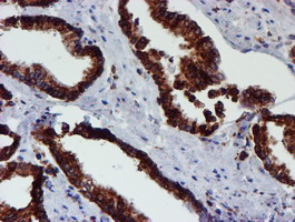 PDIA4 / ERP72 Antibody - IHC of paraffin-embedded Carcinoma of Human prostate tissue using anti-PDIA4 mouse monoclonal antibody. (Heat-induced epitope retrieval by 10mM citric buffer, pH6.0, 100C for 10min).
