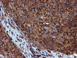 PDIA4 / ERP72 Antibody - IHC of paraffin-embedded Carcinoma of Human bladder tissue using anti-PDIA4 mouse monoclonal antibody. (Heat-induced epitope retrieval by 10mM citric buffer, pH6.0, 100C for 10min).