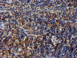 PDIA4 / ERP72 Antibody - IHC of paraffin-embedded Human lymphoma tissue using anti-PDIA4 mouse monoclonal antibody. (Heat-induced epitope retrieval by 10mM citric buffer, pH6.0, 100C for 10min).