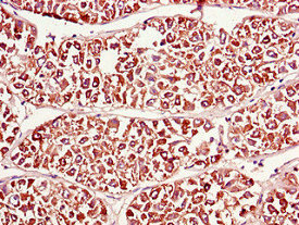 PDIA4 / ERP72 Antibody - Immunohistochemistry of paraffin-embedded human liver cancer using PDIA4 Antibody at dilution of 1:100