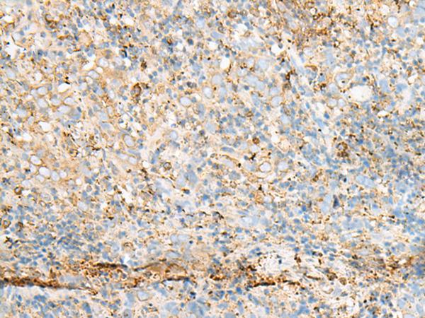 PDIA4 / ERP72 Antibody - Immunohistochemistry of paraffin-embedded Human cervical cancer tissue  using PDIA4 Polyclonal Antibody at dilution of 1:50(×200)