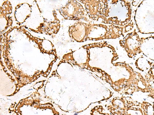 PDIA4 / ERP72 Antibody - Immunohistochemistry of paraffin-embedded Human thyroid cancer tissue  using PDIA4 Polyclonal Antibody at dilution of 1:50(×200)