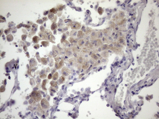 PDIA6 / ERP5 Antibody - Immunohistochemical staining of paraffin-embedded Carcinoma of Human lung tissue using anti-ATP6V1C2 mouse monoclonal antibody. (Heat-induced epitope retrieval by 1mM EDTA in 10mM Tris buffer. (pH8.5) at 120 oC for 3 min. (1:150)