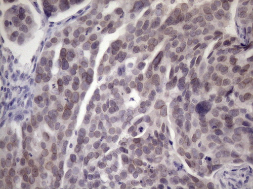PDIA6 / ERP5 Antibody - Immunohistochemical staining of paraffin-embedded Adenocarcinoma of Human ovary tissue using anti-ATP6V1C2 mouse monoclonal antibody. (Heat-induced epitope retrieval by 1mM EDTA in 10mM Tris buffer. (pH8.5) at 120 oC for 3 min. (1:150)