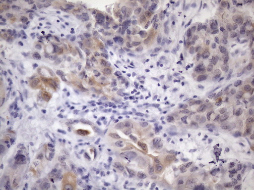PDIA6 / ERP5 Antibody - Immunohistochemical staining of paraffin-embedded Adenocarcinoma of Human endometrium tissue using anti-ATP6V1C2 mouse monoclonal antibody. (Heat-induced epitope retrieval by 1mM EDTA in 10mM Tris buffer. (pH8.5) at 120 oC for 3 min. (1:150)