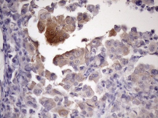 PDIA6 / ERP5 Antibody - Immunohistochemical staining of paraffin-embedded Adenocarcinoma of Human endometrium tissue using anti-ATP6V1C2 mouse monoclonal antibody. (Heat-induced epitope retrieval by 1mM EDTA in 10mM Tris buffer. (pH8.5) at 120 oC for 3 min. (1:150)