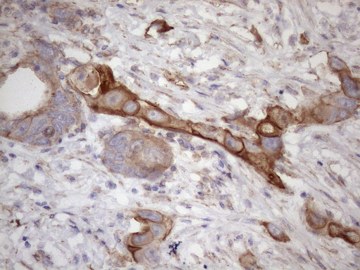 PDIA6 / ERP5 Antibody - Immunohistochemical staining of paraffin-embedded Adenocarcinoma of Human colon tissue using anti-ATP6V1C2 mouse monoclonal antibody. (Heat-induced epitope retrieval by 1mM EDTA in 10mM Tris buffer. (pH8.5) at 120 oC for 3 min. (1:150)