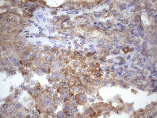 PDIA6 / ERP5 Antibody - Immunohistochemical staining of paraffin-embedded Carcinoma of Human kidney tissue using anti-ATP6V1C2 mouse monoclonal antibody. (Heat-induced epitope retrieval by 1mM EDTA in 10mM Tris buffer. (pH8.5) at 120 oC for 3 min. (1:150)