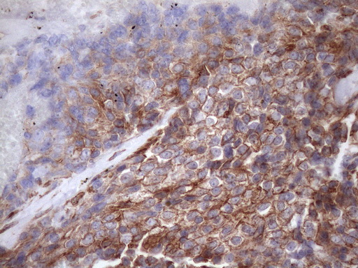 PDIA6 / ERP5 Antibody - Immunohistochemical staining of paraffin-embedded Adenocarcinoma of Human breast tissue using anti-ATP6V1C2 mouse monoclonal antibody. (Heat-induced epitope retrieval by 1mM EDTA in 10mM Tris buffer. (pH8.5) at 120 oC for 3 min. (1:150)
