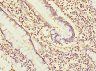 PDIA6 / ERP5 Antibody - Immunohistochemistry of paraffin-embedded human colon cancer at dilution 1:100