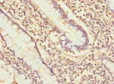 PDIA6 / ERP5 Antibody - Immunohistochemistry of paraffin-embedded human colon cancer at dilution 1:100