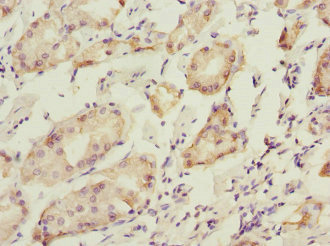 PDIA6 / ERP5 Antibody - Immunohistochemistry of paraffin-embedded human gastric cancer at dilution 1:100