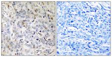 PDIK1L Antibody - Immunohistochemistry analysis of paraffin-embedded human breast carcinoma tissue, using PDIK1L Antibody. The picture on the right is blocked with the synthesized peptide.
