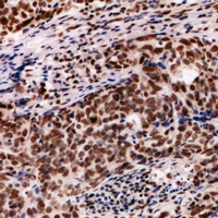 PDIK1L Antibody - Immunohistochemical analysis of PDIK1L staining in human breast cancer formalin fixed paraffin embedded tissue section. The section was pre-treated using heat mediated antigen retrieval with sodium citrate buffer (pH 6.0). The section was then incubated with the antibody at room temperature and detected using an HRP conjugated compact polymer system. DAB was used as the chromogen. The section was then counterstained with haematoxylin and mounted with DPX.