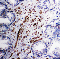 PDK1 Antibody - PDK1 antibody. IHC(P):Human Prostatic Cancer Tissue.