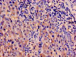 PDK1 Antibody - Immunohistochemistry image of paraffin-embedded human liver cancer at a dilution of 1:100