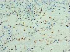 PDK2 Antibody - Immunohistochemistry of paraffin-embedded human breast cancer using antibody at 1:100 dilution.