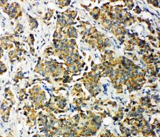 PDK2 Antibody - PDK2 antibody. IHC(P): Human Breast Cancer Tissue.
