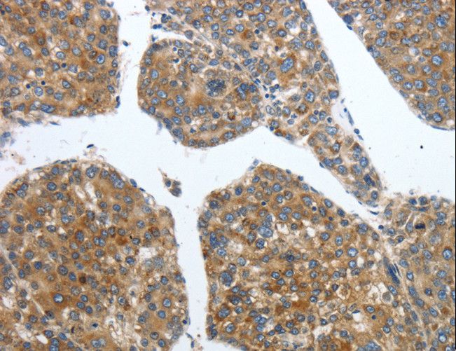 PDK2 Antibody - Immunohistochemistry of paraffin-embedded Human liver cancer using PDK2 Polyclonal Antibody at dilution of 1:40.