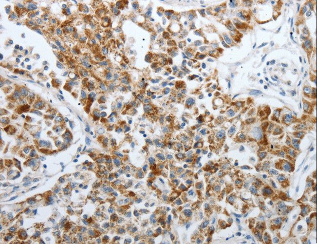 PDK2 Antibody - Immunohistochemistry of paraffin-embedded Human lung cancer using PDK2 Polyclonal Antibody at dilution of 1:40.