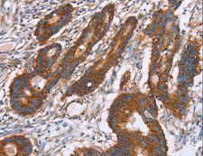PDLIM1 Antibody - Immunohistochemistry of paraffin-embedded Human colon cancer using PDLIM1 Polyclonal Antibody at dilution of 1:30.