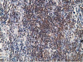 PDLIM2 / SLIM Antibody - IHC of paraffin-embedded Human lymphoma tissue using anti-PDLIM2 mouse monoclonal antibody.