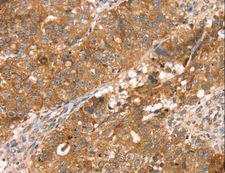 PDLIM4 / RIL Antibody - Immunohistochemistry of paraffin-embedded Human breast cancer using PDLIM4 Polyclonal Antibody at dilution of 1:30.