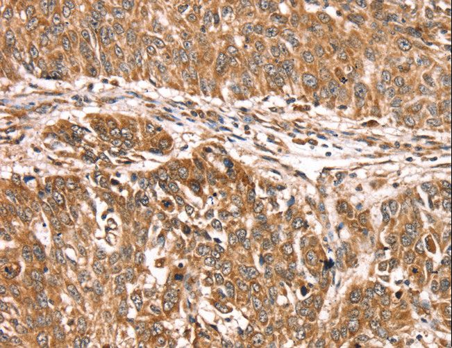 PDLIM4 / RIL Antibody - Immunohistochemistry of paraffin-embedded Human lung cancer using PDLIM4 Polyclonal Antibody at dilution of 1:30.