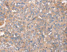 PDLIM4 / RIL Antibody - Immunohistochemistry of paraffin-embedded Human breast cancer using PDLIM4 Polyclonal Antibody at dilution of 1:40.