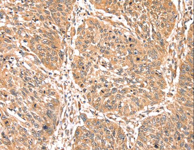 PDLIM4 / RIL Antibody - Immunohistochemistry of paraffin-embedded Human lung cancer using PDLIM4 Polyclonal Antibody at dilution of 1:40.