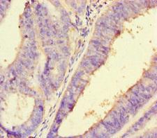 PDLIM5 / LIM Antibody - Immunohistochemistry of paraffin-embedded human endometrial cancer at dilution of 1:100