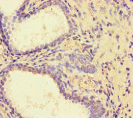 PDLIM5 / LIM Antibody - Immunohistochemistry of paraffin-embedded human prostate cancer at dilution of 1:100
