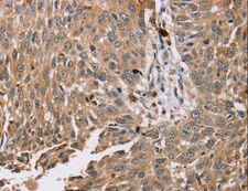 PDLIM7 / Enigma Antibody - Immunohistochemistry of paraffin-embedded Human esophagus cancer using PDLIM7 Polyclonal Antibody at dilution of 1:35.