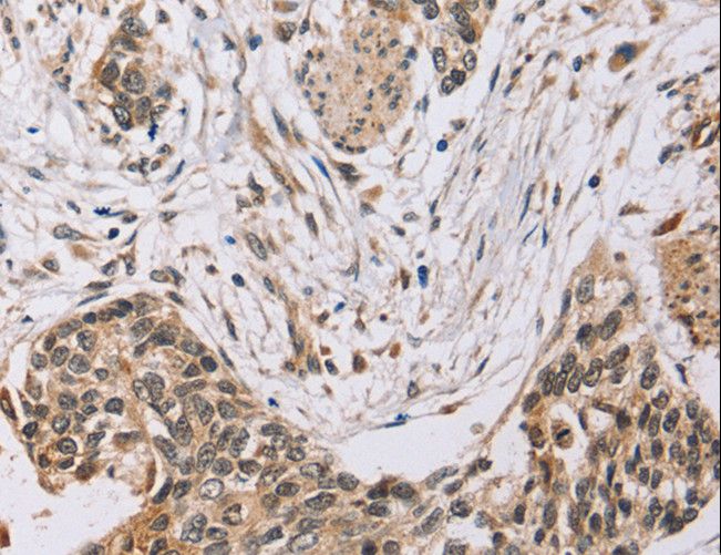 PDLIM7 / Enigma Antibody - Immunohistochemistry of paraffin-embedded Human esophagus cancer using PDLIM7 Polyclonal Antibody at dilution of 1:35.